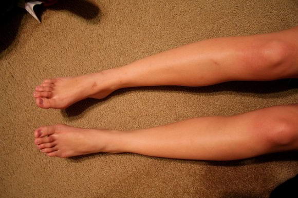 laser-endovascolare laser endovascolare