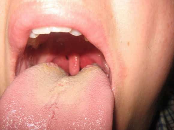 Tonsillite acuta