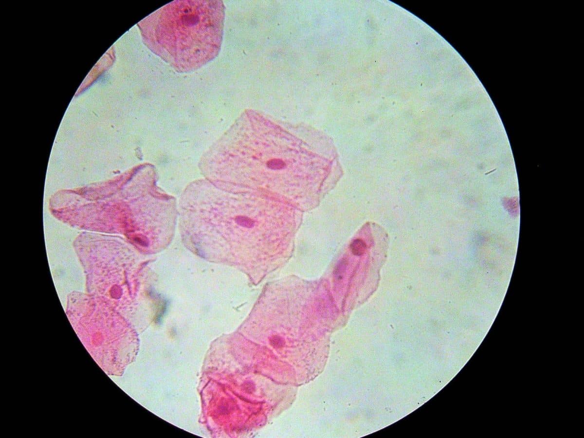 Cellule Epiteliali Nelle Urine Quando Preoccuparsi