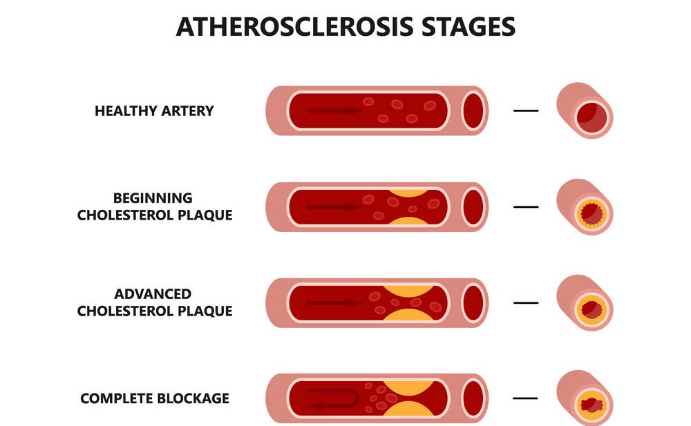 aterosclerosi-dovuta-a-trigliceridi-alti