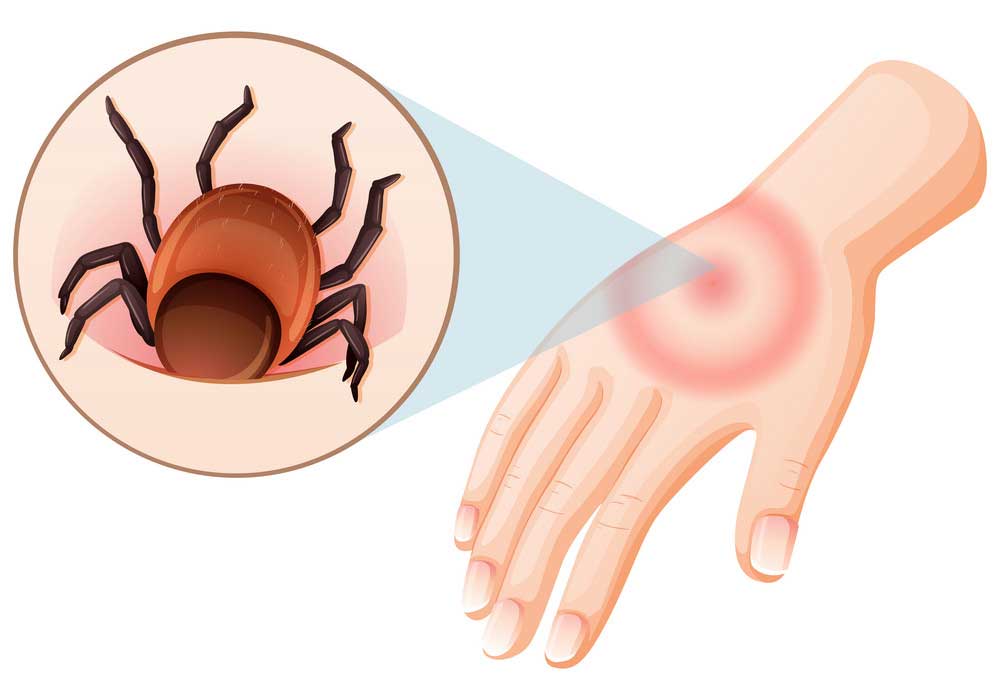 eruzione-cutanea-dopo-morso-zecca
